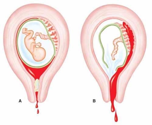 El aborto incompleto ocurre cuando parte del tejido se queda dentro del útero. Al no ser identificado y tratado de forma adecuada y a tiempo, lleva a una infección severa que pone en riesgo la vida.