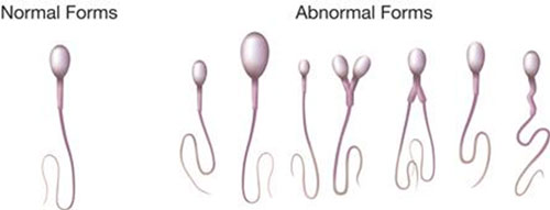 espermatozoides forma normal y forma anormal