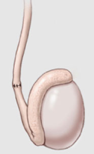 La vasovasostomía (o vaso-vaso anastomosis) que re-conecta los dos cabos del conducto deferente