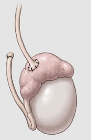 La vaso epididimostomía (o vaso-epidídimo anastomosis) que conecta el vaso deferente hacia el epidídimo, en donde se almacena el esperma.