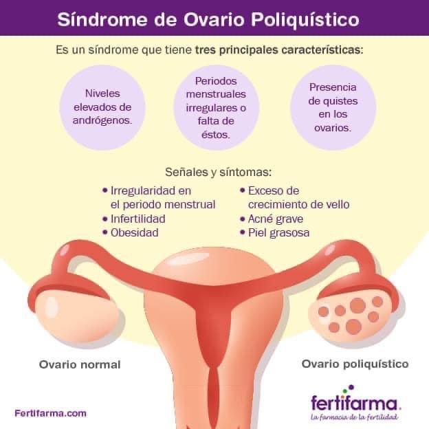 características del síndrome de ovario poliquístico