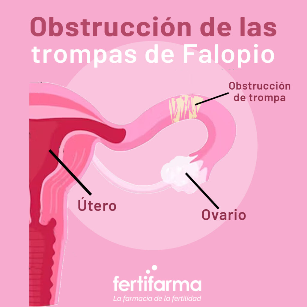 obstrucción de las trompas de Falopio
