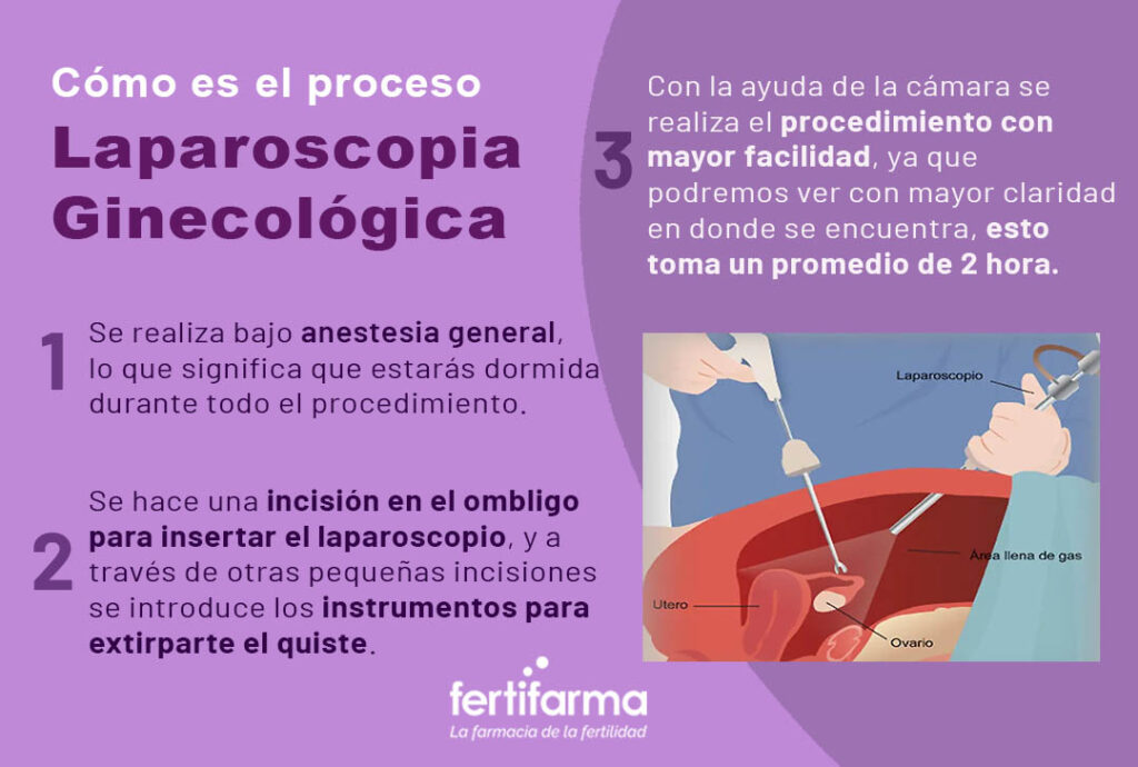 Cómo es el proceso de Laparoscopia Ginecológica 