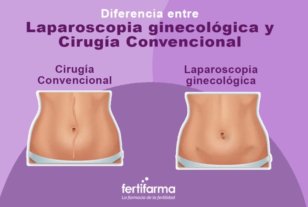 Diferencia de laparoscopia ginecológica y cirugía convencional 